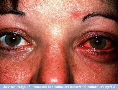 Konjunktivitis (Entzündung des Auges). Was ist Bindehautentzündung?
