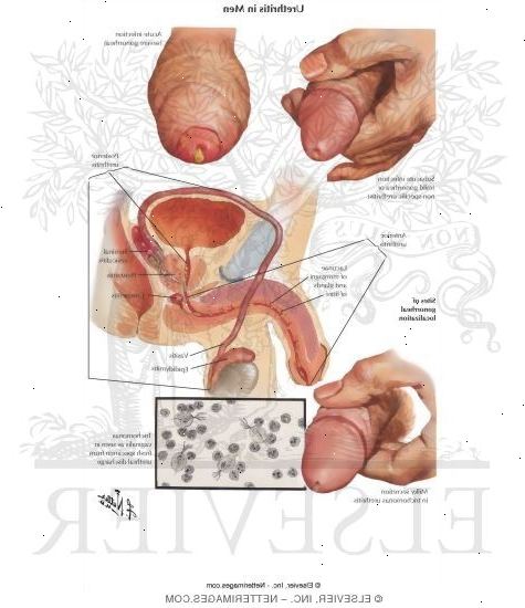 Urethritis. unspezifische Urethritis (NSU).