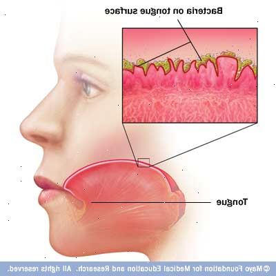Mundgeruch (Halitosis). was verursacht schlechten Atem?