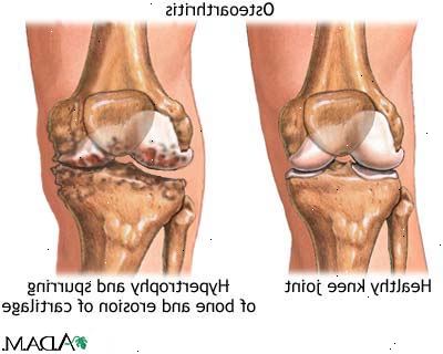 Osteoarthritis. Was ist Arthrose?