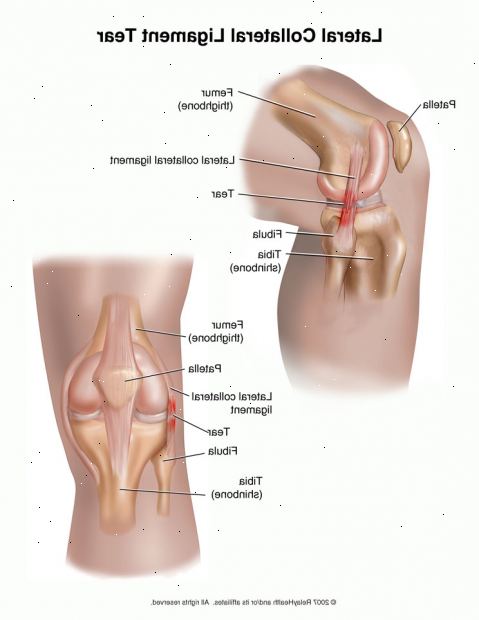 Knieverletzungen - Kollateralbänder. welche Arten von Knieverletzungen gibt es?
