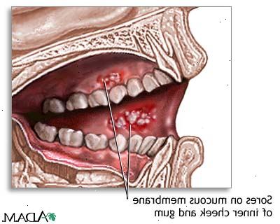 Geschwüre im Mund. Zahnfleischerkrankungen und bakteriellen Infektionen.